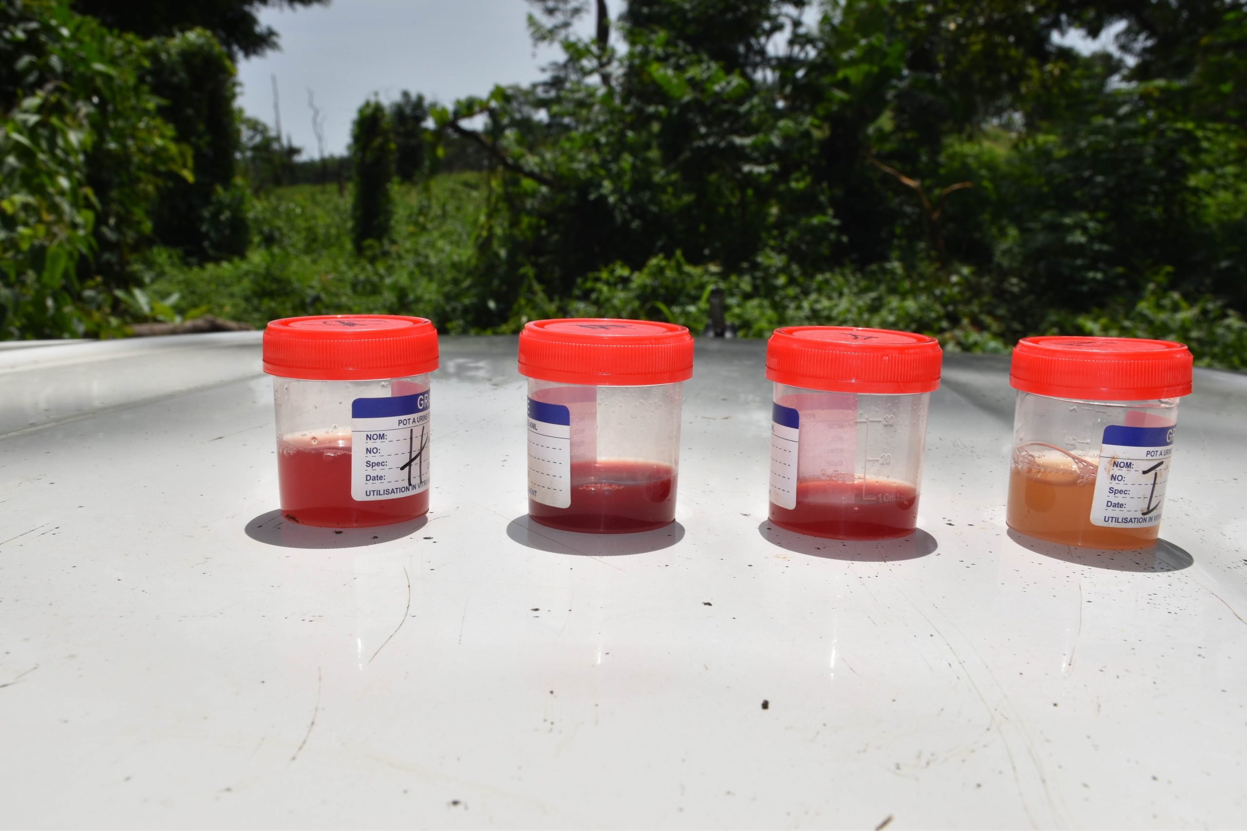 Visible haematuria observed during field screening in Mambonko village